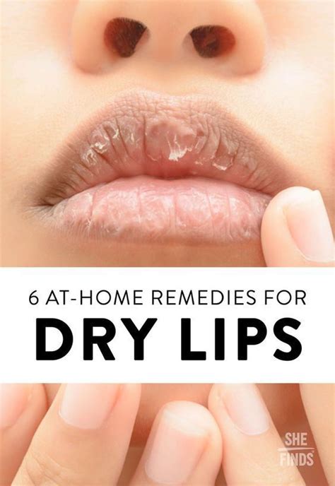 5 Tips for Battling Dry Lips | Dry lips remedy, Dry lips, Skin remedies