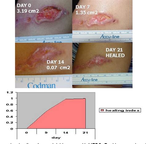 [PDF] MOISTURE AND WOUND HEALING | Semantic Scholar