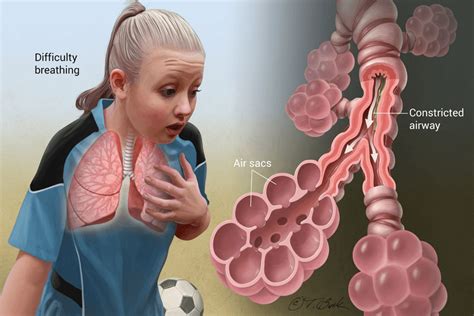 How To Control BRONCHIAL ASTHMA — Wubmed.org