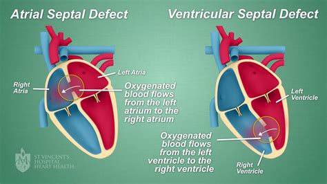 Septal Defect "Hole in the heart" Closures - St Vincent's Heart Health