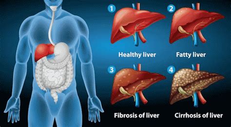 What Is Liver Cirrhosis? Symptoms, Causes, and Treatment