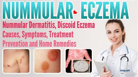 Nummular Eczema: Causes And How To Get Rid Of It, 42% OFF