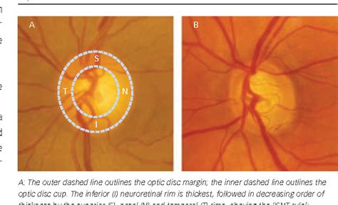 Figure 2 from Clinical Optic Disc Evaluation in Glaucoma | Semantic Scholar