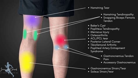 Knee Pain Causes Chart | Porn Sex Picture