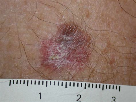 Síntomas y signos del melanoma - Medicina Básica