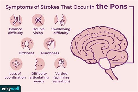 Medial Pontine Syndrome