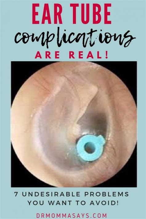 Avoid 7 Undesirable Ear Tube Complications with Routine Checkups - Dr ...