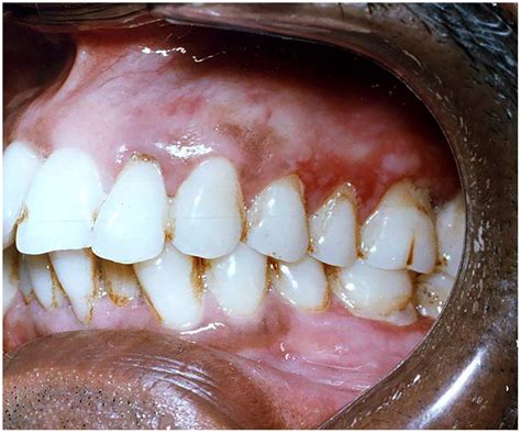 Linear Gingival Erythema