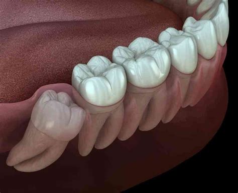 Impaksi, Gigi Bungsu Bermasalah yang Menyakitkan Halaman 1 - Kompasiana.com
