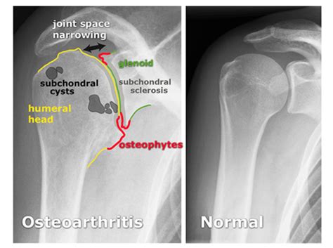 Glenohumeral Osteoarthritis | Hawaii Sports & Balance Center