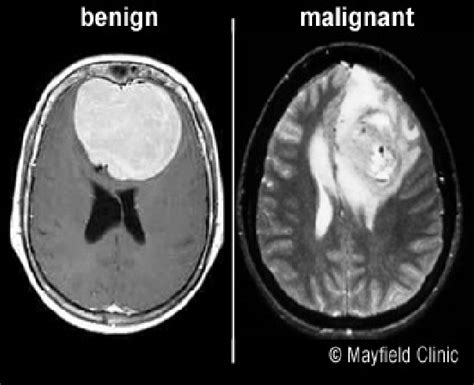 MRI scan of benign and malignant brain tumors | Download Scientific Diagram