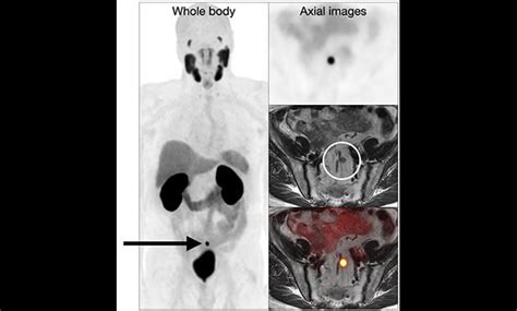 Prostate Specific Membrane Antigen (PSMA) PET | UCSF Radiology