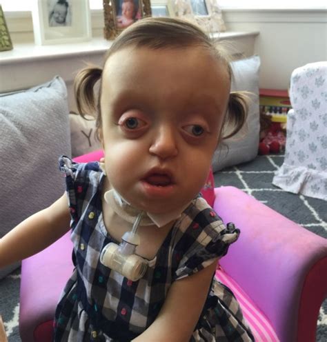 Girl born with severely deformed head smiles despite strangers ...