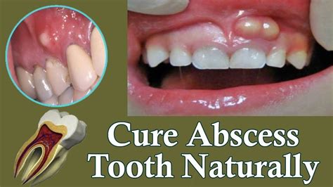 Gum Abscess All About Dental Abscesses Tooth Abscesses And Drainage ...