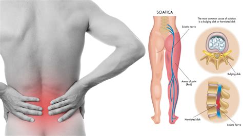 Sciatic Nerve Anatomy - Premierechiro