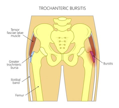 Common Hip Injuries - My Family Physio