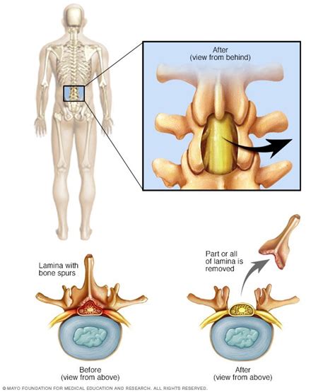 Laminectomy - Drugs.com