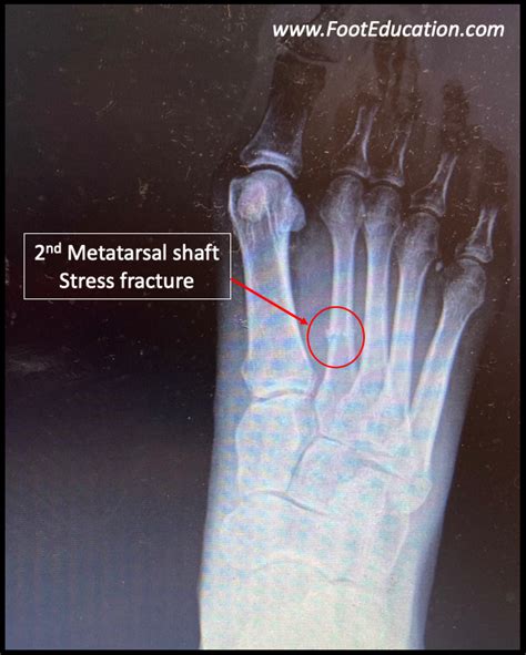 Metatarsal Stress Fracture Mri