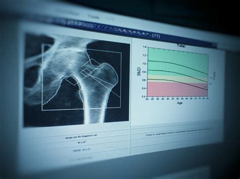 Densitometría ósea: ¿Cuándo se debe realizar este examen? : Clínica ...
