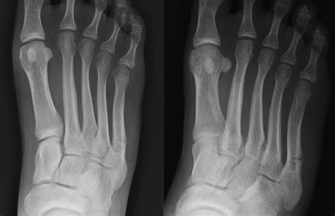 Jones Fracture — Chicago Foot & Ankle Orthopaedic Surgeons