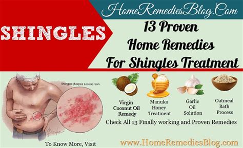 13 Powerful Home Remedies For Shingles Treatment - Home Remedies Blog