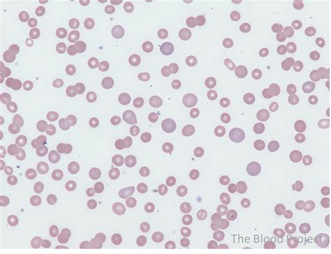 Warm Autoimmune Hemolytic Anemia • The Blood Project