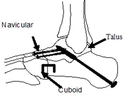 Triple Arthrodesis Foot Surgery - Atlanta Foot & Ankle Doctor