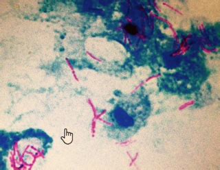 Mycobacterium Tuberculosis – Part 3 – AFB Culture (Acid Fast Bacilli ...