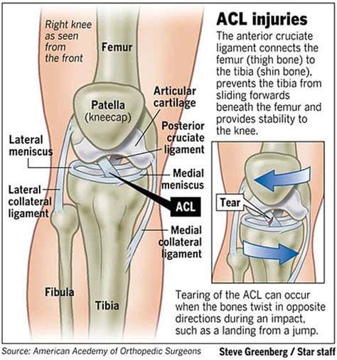 ACL rehab – thinking beyond typical protocols – POST COMPETITIVE INSIGHT