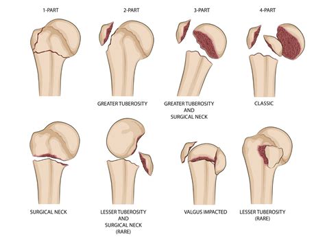 Auckland Shoulder Clinic | Rehab for your humeral head fracture