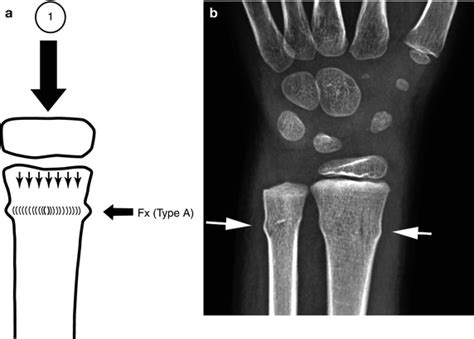 Greenstick Fracture X Ray