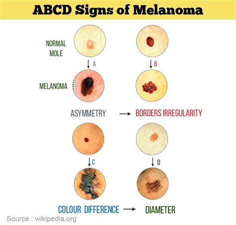 Melanoma - Causes, Symptoms, Diagnosis, Treatment, Prevention