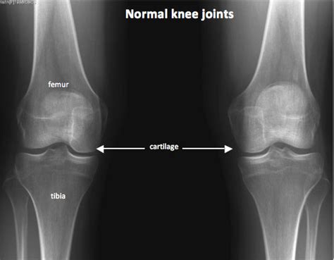 Knee Xray - Upper West Side, Columbus Circle New York, NY