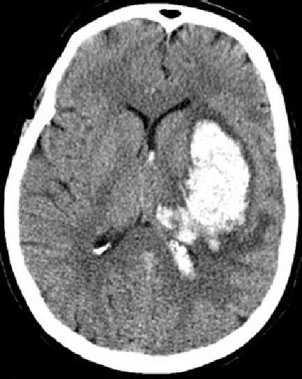 Stroke Ct Scan