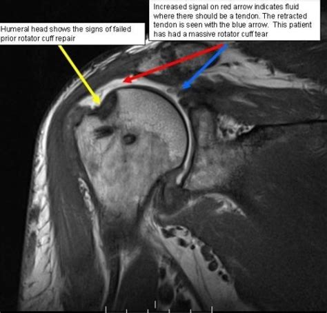 Reverse Shoulder Replacement | Boston Shoulder Institute