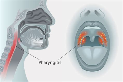 Acute pharyngitis: Causes, symptoms, diagnosis and treatment