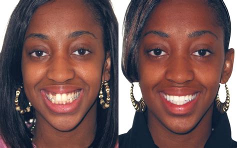 Braces Before And After Smile