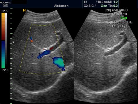 Ultrasound images • Liver blood flow, color doppler, echogramm №395