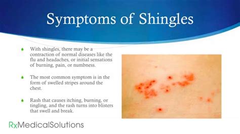 Shingles Pain Relief - YouTube