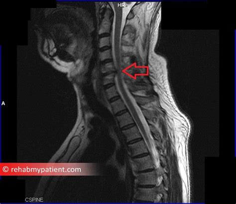 Cervical Radiculopathy (Pinched Nerve) | Rehab My Patient