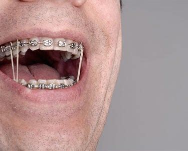 Rubber Bands for Braces | Dr. W. Gray Grieve Orthodontics