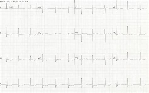 QT Interval • LITFL • ECG Library Basics