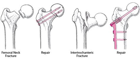 Table: Repairing a Fractured Hip - MSD Manual Consumer Version