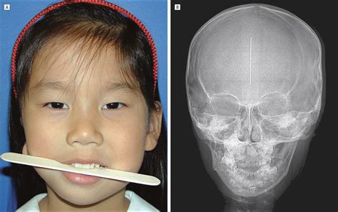 Isolated Microtia as a Marker for Unsuspected Hemifacial Microsomia ...