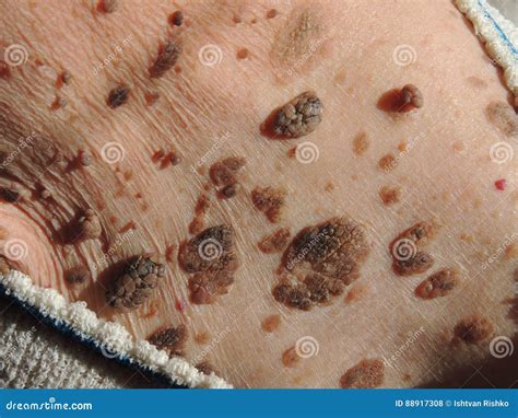 Many Mole on the Skin of Elderly Woman Stock Photo - Image of close ...