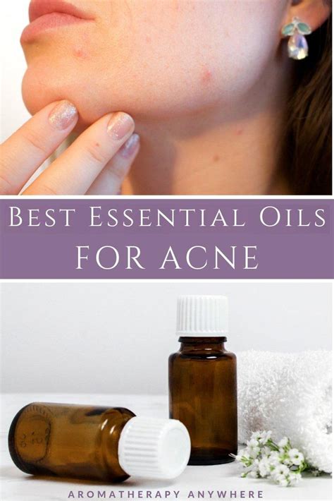 Best Essential Oils To Combat Acne + Anti-Acne Recipes - Aromatherapy ...