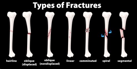 Overcoming Stress from Hairline Fractures - Triangle Physiotherapy