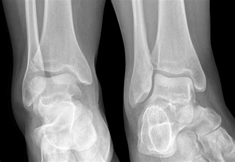 Tillaux fracture • LITFL • Medical Eponym Library