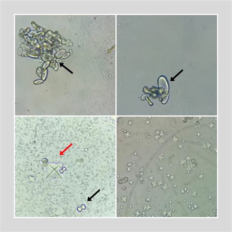 Calcium Oxalate Dihydrate Crystals In Urine