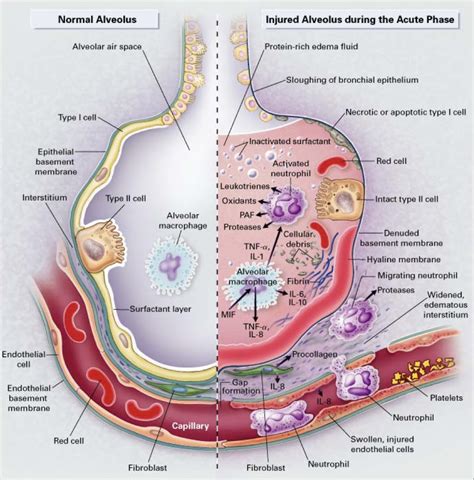 Critical Care/Lung Injury | UCSF Pulmonary, Critical Care, Allergy and ...